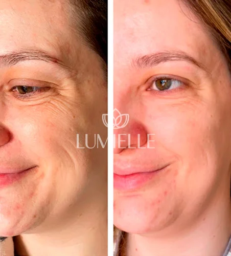 LUMIELLE-PRV-1-1.webp